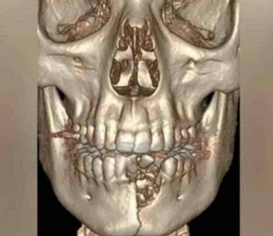 سيجارة إلكترونية تشوّه وجه مراهق