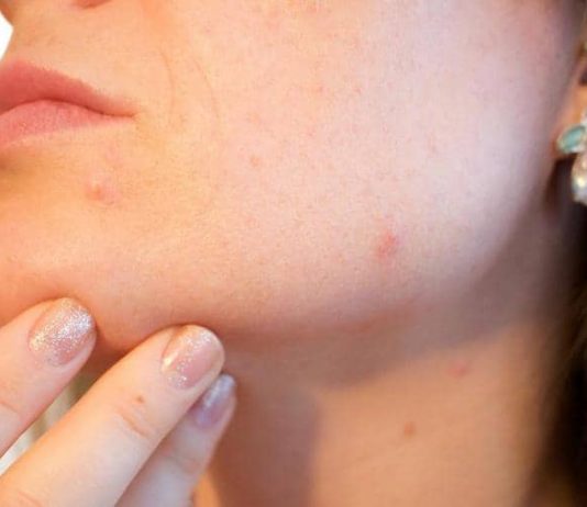 6 أغذية تسرع ظهور “حب الشباب”.. انتبهوا منها!